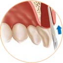 A protective membrane may be placed in the socket before adding grafting material